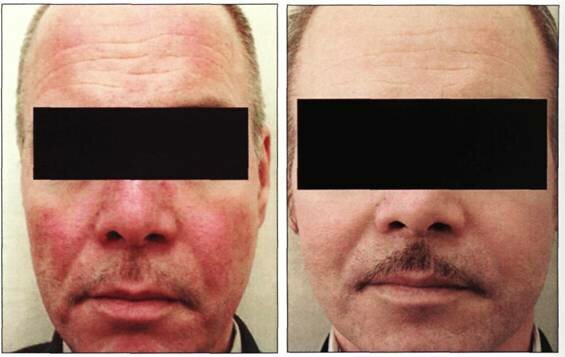 cirugia rejuvenecimiento facial arrugas